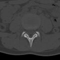 Bilateral pars defect (Radiopaedia 26691-26846 Axial bone window 14).jpg
