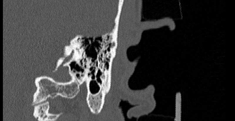 File:Bilateral temporal bone fractures (Radiopaedia 29482-29970 B 70).jpg