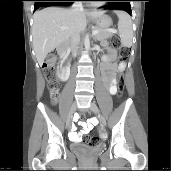 File:Bilateral ureteritis and cystitis (Radiopaedia 25340-25594 B 21).jpg