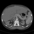 Biliary necrosis - liver transplant (Radiopaedia 21876-21846 A 26).jpg