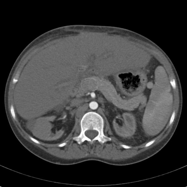 File:Biliary necrosis - liver transplant (Radiopaedia 21876-21846 A 26).jpg