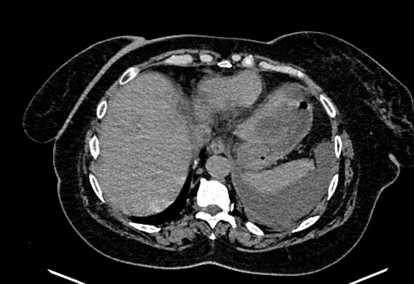 Biliary pancreatitis (Radiopaedia 72289-82823 Axial non-contrast 46).jpg