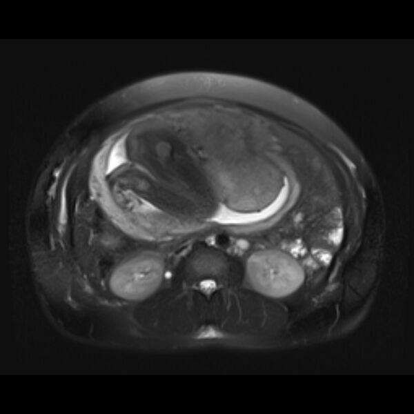 File:Bilobed placenta accreta (Radiopaedia 69648-79591 Axial T2 fat sat 13).jpg