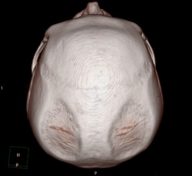 File:Biparietal osteodystrophy (Radiopaedia 46109-50463 3D 3D VR 7).jpg