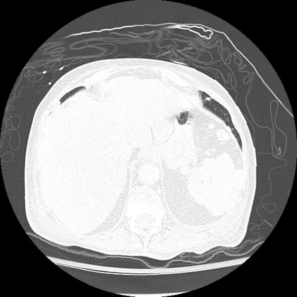 File:Bladder cancer metastases (Radiopaedia 9824-10409 Axial lung window 12).jpg