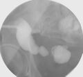 Bladder exstrophy and ileal conduit stones (Radiopaedia 35761-37310 cystogram 1).JPG