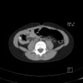 Bochdalek diaphragmatic hernia (Radiopaedia 38866-41059 A 36).jpg