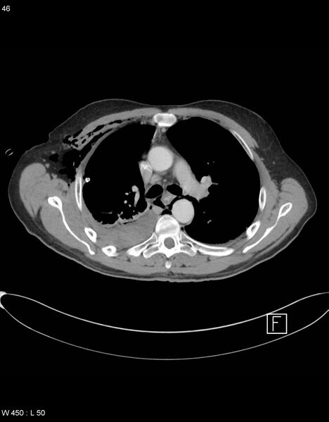 File:Boerhaave syndrome with tension pneumothorax (Radiopaedia 56794-63605 A 22).jpg