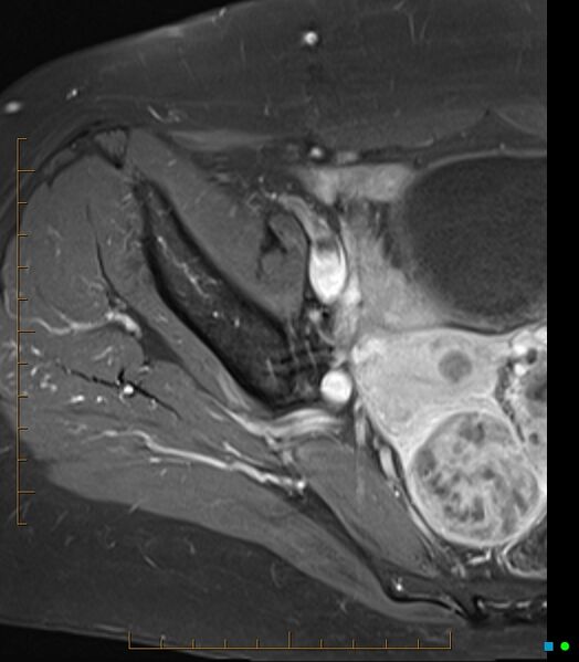File:Bone metastasis - breast cancer (Radiopaedia 16667-16374 Axial T1 C+ fat sat 20).jpg