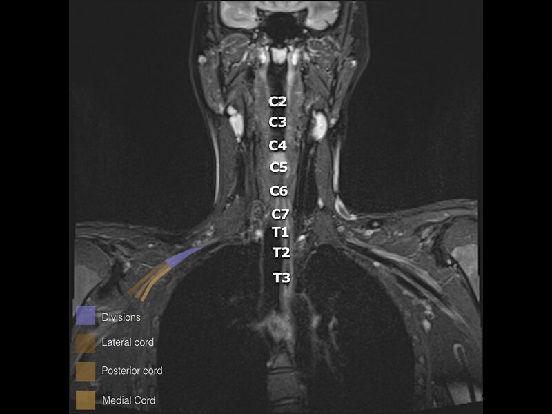 File:Brachial plexus anatomy (Radiopaedia 64414-73226 Coronal STIR 17).jpeg