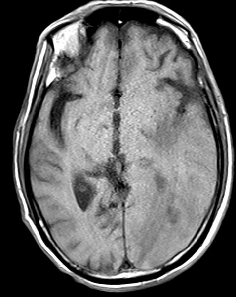 File:Brain abscess with dual rim sign (Radiopaedia 87566-103938 Axial T1 11).jpg