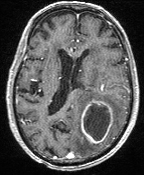 File:Brain abscess with dual rim sign (Radiopaedia 87566-103938 Axial T1 C+ 98).jpg