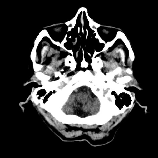 File:Brain metastases from lung cancer (Radiopaedia 27849-28092 Axial non-contrast 7).jpg