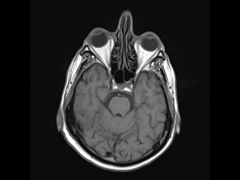 File:Brain metastases from renal cell carcinoma (Radiopaedia 42222-45297 Axial T1 9).jpg