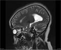 Brainstem glioma (Radiopaedia 21819-21775 Sagittal T2 20).jpg