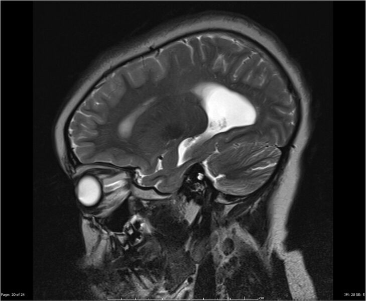 File:Brainstem glioma (Radiopaedia 21819-21775 Sagittal T2 20).jpg