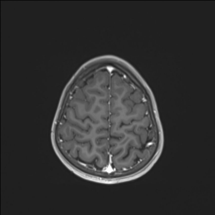 Brainstem glioma (Radiopaedia 70548-80674 Axial T1 C+ 130).jpg