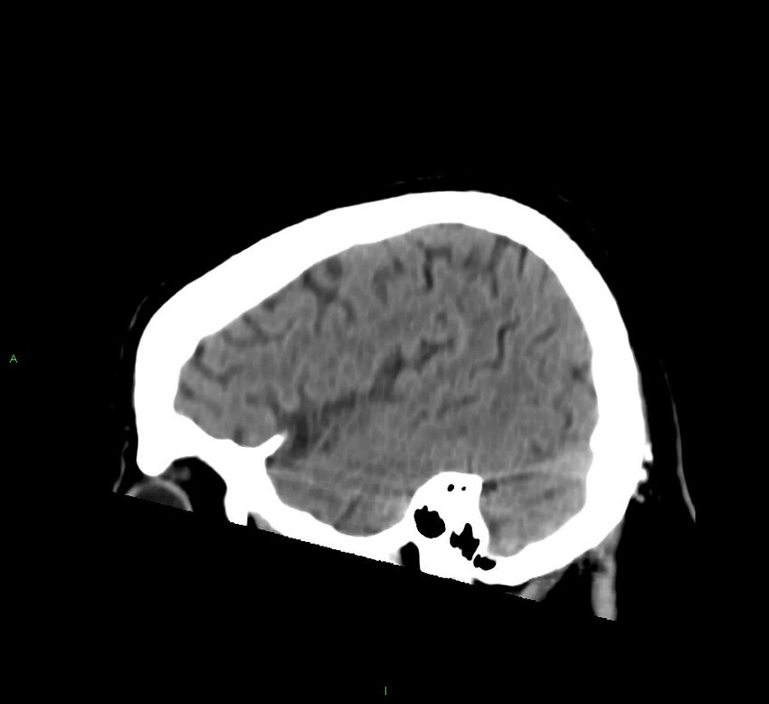 Brainstem hemorrhage (Radiopaedia 58794-66028 C 11).jpg