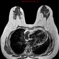 Breast carcinoma (multicentric multifocal in mammary Paget disease) (Radiopaedia 50966-56512 Axial T1 6).jpg