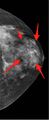 Breast hamartoma (Radiopaedia 23800-23942 C 1).png