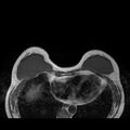 Breast implants - MRI (Radiopaedia 26864-27035 Axial T1 17).jpg