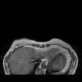 Breast implants - MRI (Radiopaedia 26864-27035 Axial T1 5).jpg