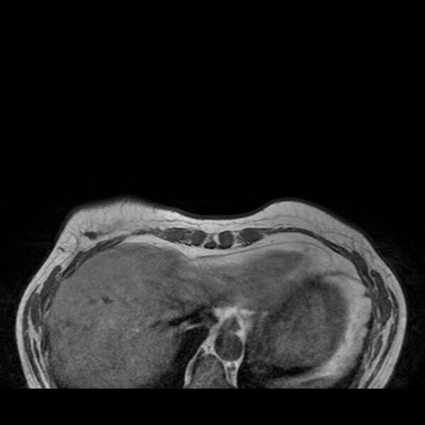 File:Breast implants - MRI (Radiopaedia 26864-27035 Axial T1 5).jpg