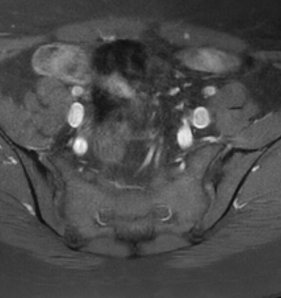 File:Broad ligament leiomyoma (Radiopaedia 81634-95516 Axial T1 C+ fat sat 5).jpg