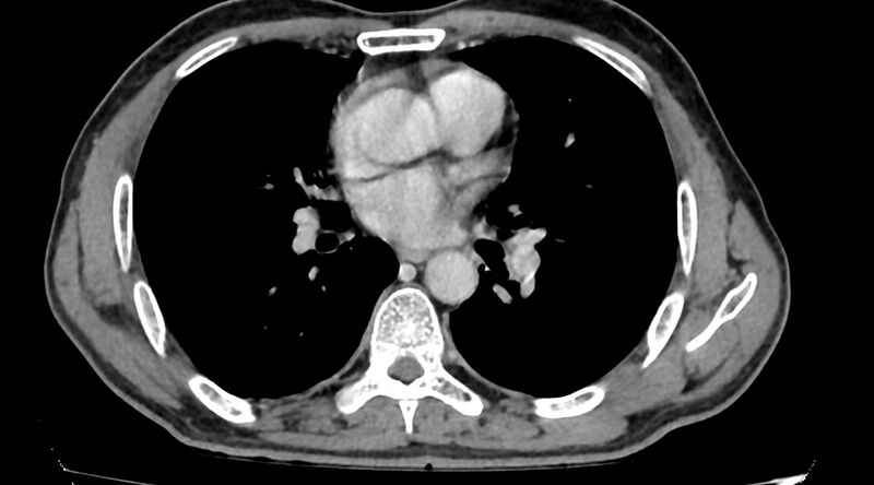 File:Bronchogenic carcinoma with superior vena cava syndrome (Radiopaedia 36497-38054 Axial C+ delayed 55).jpg