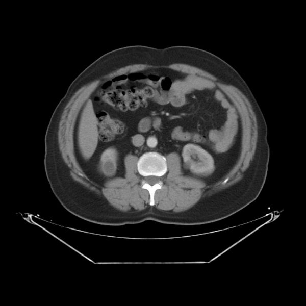 File:Bronchogenic carcinoma with upper lobe collapse (Radiopaedia 29297-29726 C 40).jpg