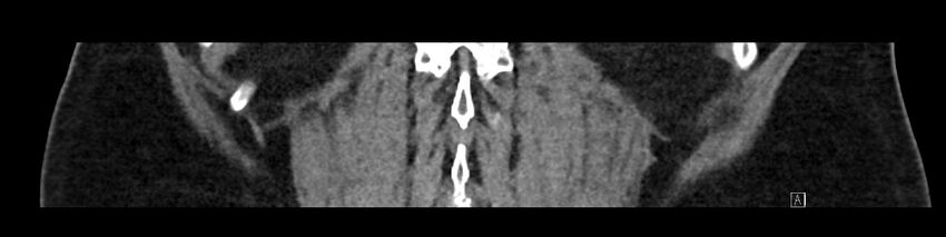 Buried bumper syndrome - gastrostomy tube (Radiopaedia 63843-72575 Coronal Inject 85).jpg