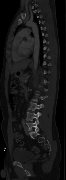 File:Burst fracture (Radiopaedia 83168-97542 Sagittal bone window 75).jpg