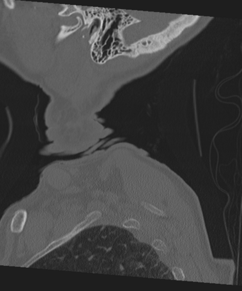 File:C2 fracture with vertebral artery dissection (Radiopaedia 37378-39199 Sagittal bone window 76).png