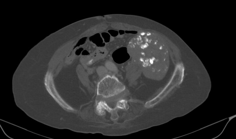 File:Calcified fibroids (Radiopaedia 20306-20228 Axial bone window 7).jpg