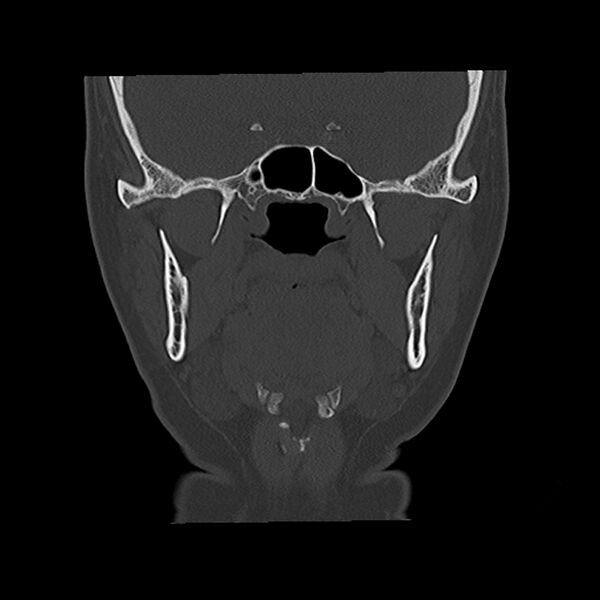 File:Canal up mastoidectomy (Radiopaedia 78108-90638 Coronal bone window 22).jpg