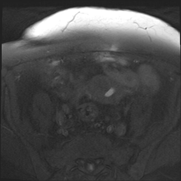 File:Cancer cervix - stage IIb (Radiopaedia 75411-86615 T1 fat sat 25).jpg