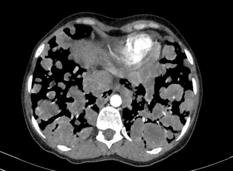 File:Cannonball metastases from breast cancer (Radiopaedia 91024-108569 A 96).jpg