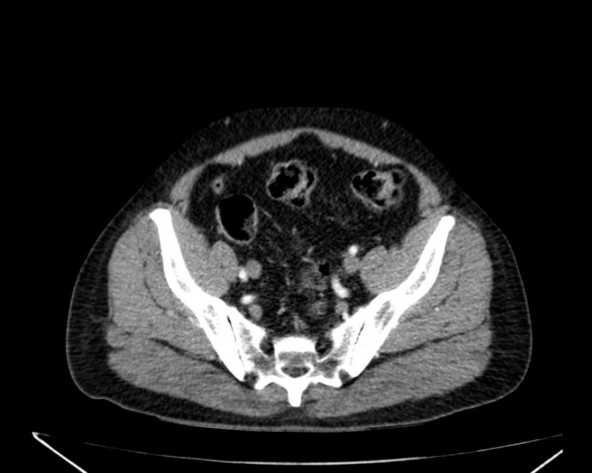 Carcinoid tumor with hepatic metastases (Radiopaedia 22651-22670 B 73).jpg