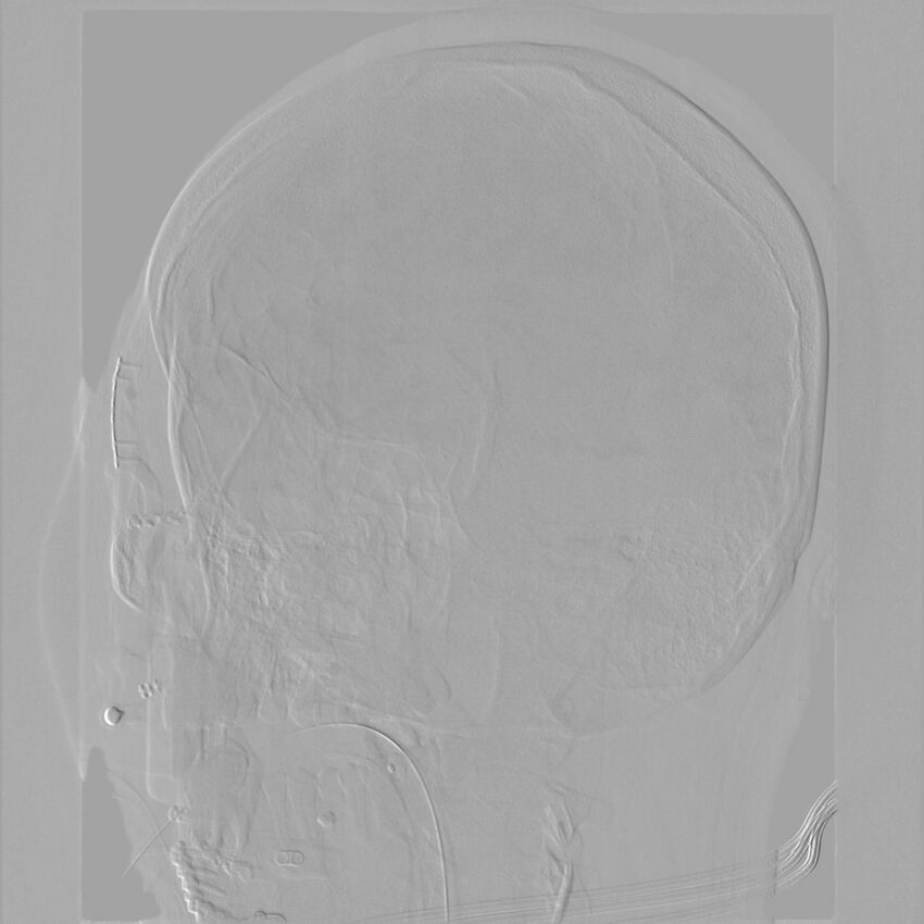 Caroticocavernous fistula - direct (Radiopaedia 61660-69666 Oblique Left ICA 43).jpg