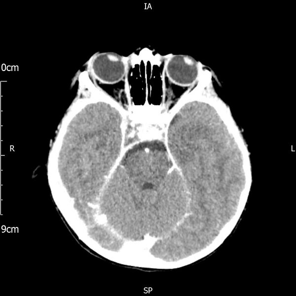 File:Cavernous sinus thrombosis (Radiopaedia 79414-92510 Axial Brain 80).jpg