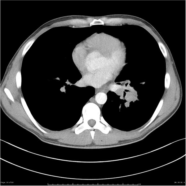 File:Cavitating lung cancer (Radiopaedia 25796-25945 C+ arterial phase 35).jpg