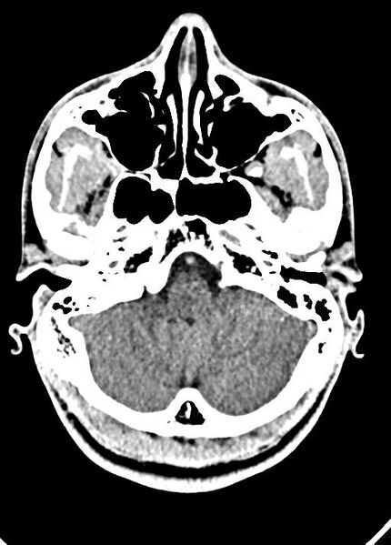 File:Cavum septum pellucidum and cavum vergae (Radiopaedia 77797-90060 Axial Brain Window 20).jpg