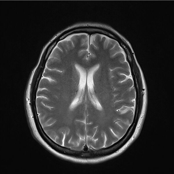 File:Central base of skull meningioma (Radiopaedia 53531-59549 Axial T2 13).jpg