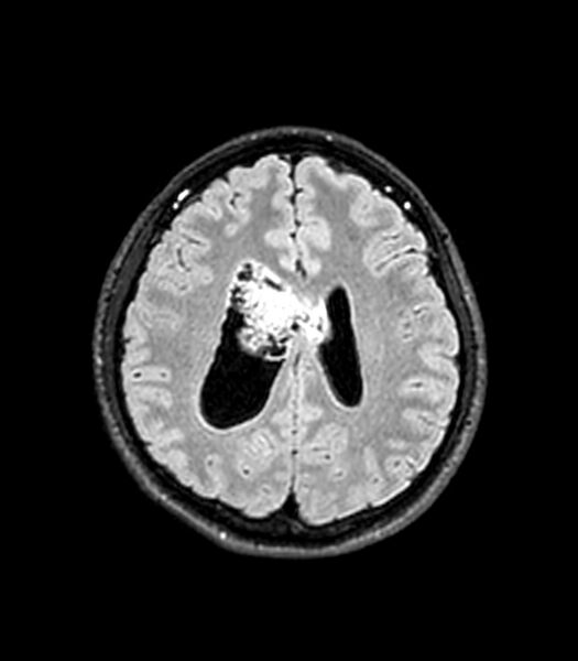 File:Central neurocytoma (Radiopaedia 79320-92380 Axial FLAIR 113).jpg