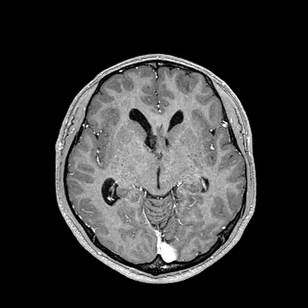 File:Central neurocytoma (Radiopaedia 79320-92380 Axial T1 C+ 115).jpg