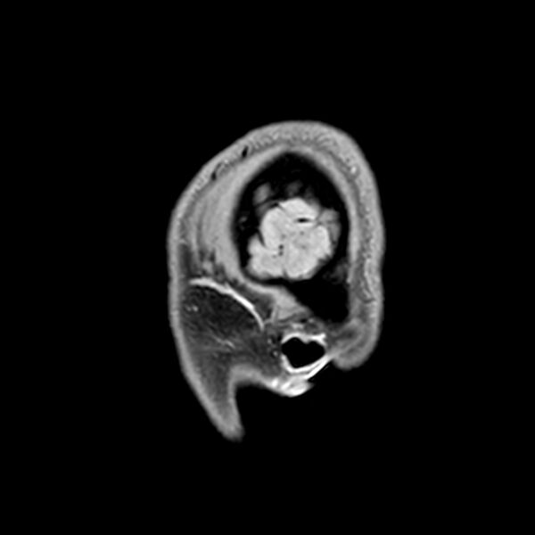File:Central neurocytoma (Radiopaedia 79320-92380 Sagittal T1 245).jpg