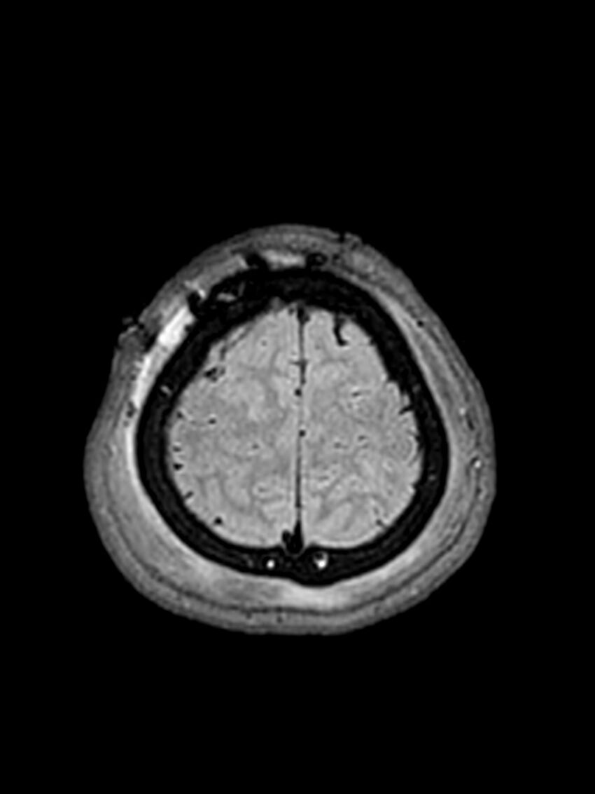 Central neurocytoma (Radiopaedia 79320-92381 Axial FLAIR 35).jpg