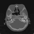 Cerebellar abscess secondary to mastoiditis (Radiopaedia 26284-26413 Axial bone window 47).jpg
