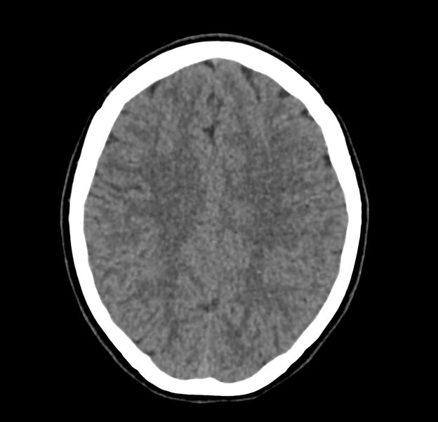 File:Cerebellar agenesis (Radiopaedia 30203-30817 Axial non-contrast 34).jpg