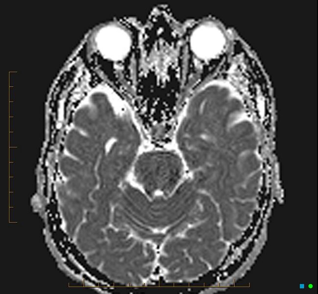 File:Cerebellar gangliocytoma (Radiopaedia 65377-74422 Axial ADC 13).jpg